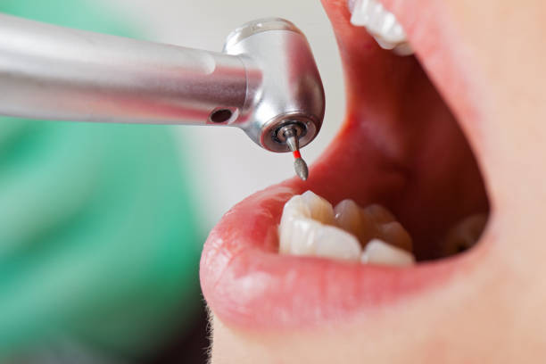 Best Emergency Wisdom Tooth Extraction in Litchfield, MI